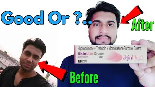 ఆ క్రీంలు వాడడం వల్ల  Skin Lite Cream Side Effects On Face  Steroid Cream  Celestee Clinic [upl. by Tniassuot]