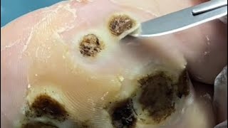 Pedicure To treat viral warts dig it out  this terrible virus wart situation【Xiao yao】 [upl. by Etteroma]