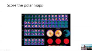 Reading a Normal Cardiac PET Scan [upl. by Unity86]