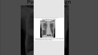 Pseudotumor signCHFradiology neetpg inicet shortsfeed [upl. by Caro912]