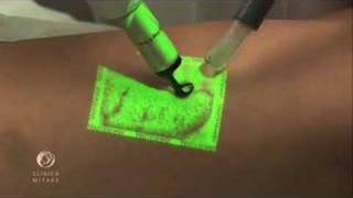 Augmented Reality VeinViewer technology on varicose veins treatment Novo Tratamento Varizes [upl. by Mayda374]