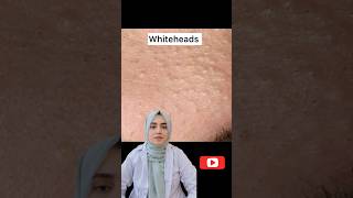 Get Acne free Skin 5 medicines for pimples blackheads and whiteheads trending viralvideo [upl. by Mathe]