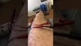 Dry Needling Treating Chronic Patella Tendinitis [upl. by Martynne]