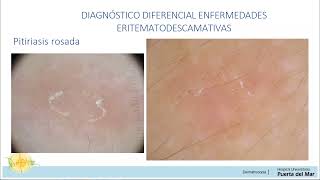 Dermatoscopia en enfermedades inflamatorias [upl. by Perusse]