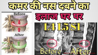 L4 L5 S1 Nerve root Compression Exercises  Buldging Disc Exercises  Herniated disc  in hindi [upl. by Nord]