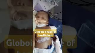 Globoid shape of head and chest baby [upl. by Elsi]