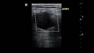 Popliteal vein aneurysm Duplex ultrasound views [upl. by Anemolihp]