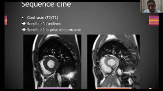 IRM cardiaque  Cardiopathie ischémique [upl. by Lauhsoj]