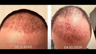 Haartransplantation Türkei  Update 2 Monat [upl. by Areek18]