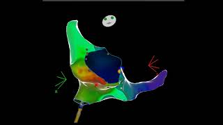 Right focal atrial tachycardia ablation [upl. by Naujek]