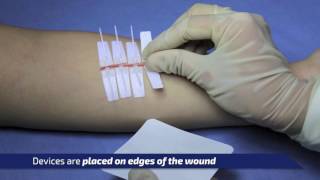 DermaClip Basic Overview a NonInvasive Wound Closure Device [upl. by Gorges]