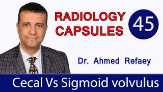 Radiology capsule  cecal vs sigmoid volvulus  Dr Ahmed Refaey [upl. by Itsa771]