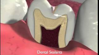 Dental Sealants and Fissurotomy [upl. by Forster219]