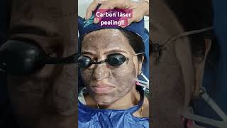 Carbon laser peeling  carbon facial  gold toning  instant peel party peel [upl. by Oecam520]