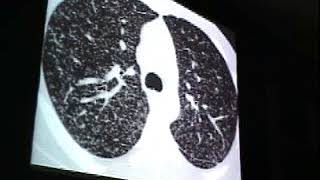 Interstitial lung disease CXR HRCT Airspace disease great [upl. by Sonya]