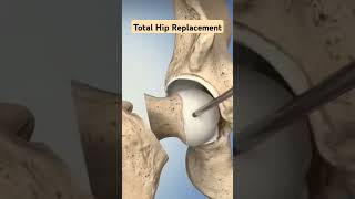 Total Hip Replacement टोटल हिप रिप्लेसमेंट मे क्या करते है Shortsorthopaedic [upl. by Ahsilam980]