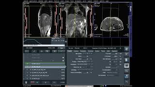 How to MRI of MRCP Planning [upl. by Namyh910]