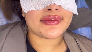 lip filler for thin lips before and after  botox for 👄 lips [upl. by Sheley461]