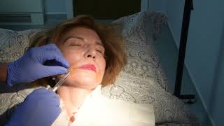 Juvederm injections to nasolabial folds [upl. by Moor]