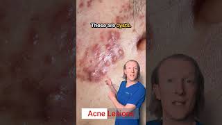 Acne Lesions White Heads Black heads Pustules Papules Cysts amp Nodules [upl. by Adal]