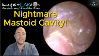 NIGHTMARE MASTOID CAVITY 242 ear earwax earwaxremoval earcleaning asmr fyp foryou satisfying [upl. by Ytteb40]