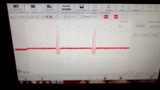 EMG recording sharing brief discharges consistent with myokymia JNSK [upl. by Maxantia417]