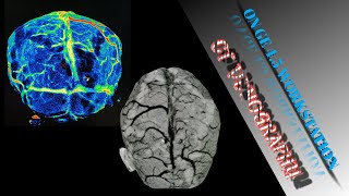 CT BRAIN VENOGRAPHY ON GE WORKSTATION 45 MAKE EASLY 🙂 [upl. by Nive]