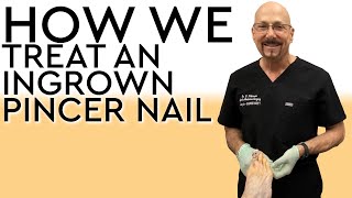 How We Treat An Ingrown Nail On The Big Toe [upl. by Brelje]