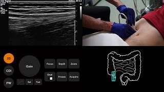 Ultrasound Tutorial AppendixAppendicitis  Radiology Nation [upl. by Martin]