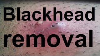 Blackhead removal [upl. by Rego617]