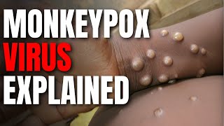 Is World Ready for Another Pandemic MONKEYPOX Virus Explained [upl. by Ybsorc]