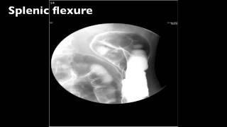 Barium Enema Double Contrast Fluoro  Step by Step Instructions [upl. by Anyrtak]