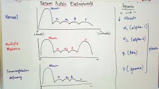 Serum Protein Electrophoresis importance and result interpretation in an easy way [upl. by Siravrat]