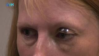 Using External Eyelid Weights In Facial Nerve Palsy [upl. by Neved585]