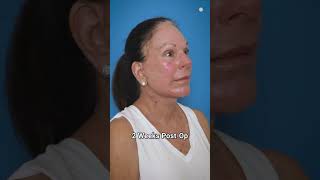 Stunning 6Month Preservation Facelift Transformation [upl. by Shakespeare826]