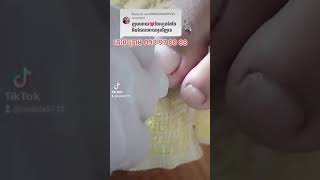 Dirt under Long toenail and clean it nail​​​ asmr fyp ear shorts viral wax [upl. by Cheney]