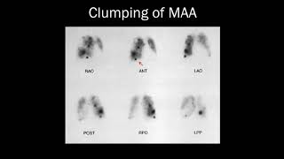 VQ Simplified Criteria for the OnCall Radiologist  15 Minute Radiology CME [upl. by Kieger]