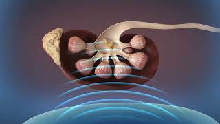 What is Shockwave Lithotripsy Kidney Stones [upl. by Japha]