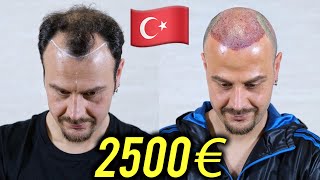 TRAPIANTO DI CAPELLI DA MEDART IN TURCHIA  il trapianto di Roberto [upl. by Viguerie]