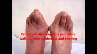 HOW TO MANAGE BUNION  Hallux Valgus both Great Toes [upl. by Iphagenia]