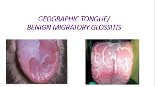 GEOGRAPHIC TONGUE [upl. by Oninrutas895]