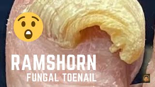 Fungal deformed toenail [upl. by Tennaj]