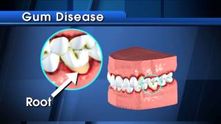 What are Cavities [upl. by Iclehc]