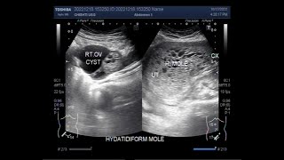 Complete Hydatidiform Mole also called Molar Pregnancy [upl. by Gemini]