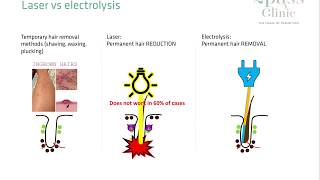 Laser hair removal vs Electrolysis [upl. by Repotsirhc]