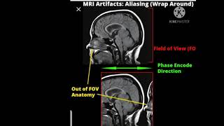 MRI Artifacts Radiology [upl. by Assila]