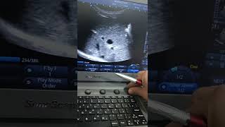 biliary cyst ē stone inside choledochal cyst type2 by ultrasound [upl. by Reifel]