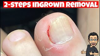 HOW TO REMOVE AN INGROWN TOENAIL [upl. by Enitselec166]