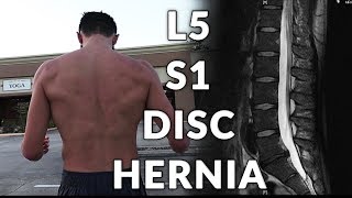 My L5 S1 Disc Hernia Miracle Cure When Physical Therapy Is Just Not Working [upl. by Maurilia]