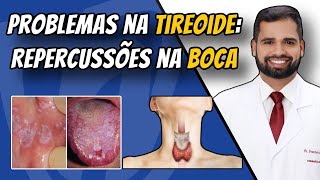 Hipotireoidismo e hipertireoidismo Sinais na boca de problemas na tireóide tireoide [upl. by Iives]